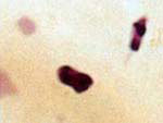Amebiasis